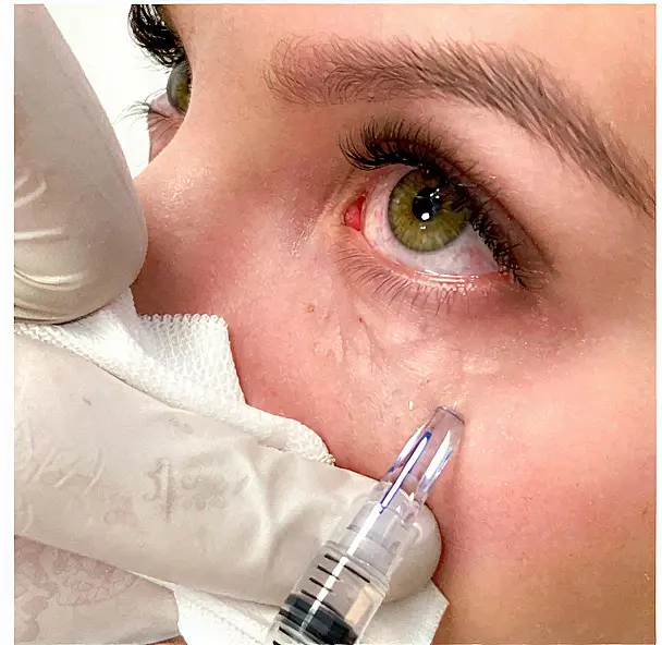 Nanosoft Microinyecciones